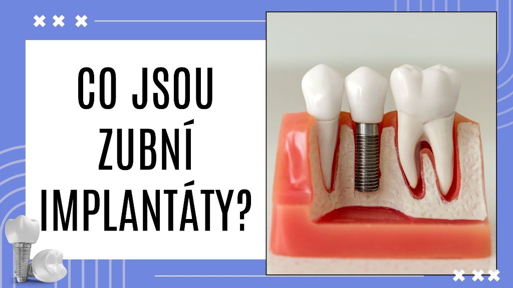 Co jsou zubní implantáty