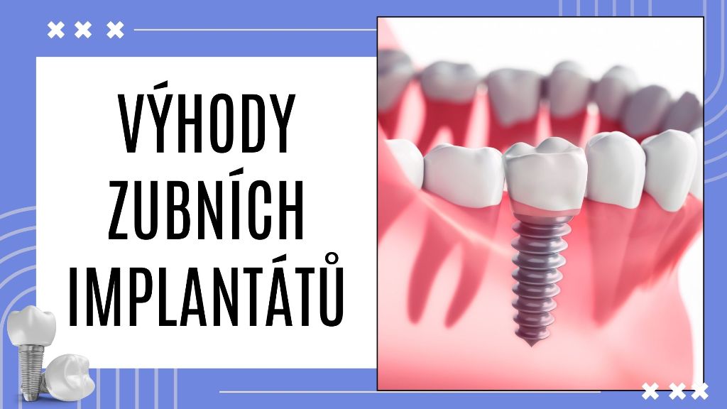 Výhody zubních implantátů