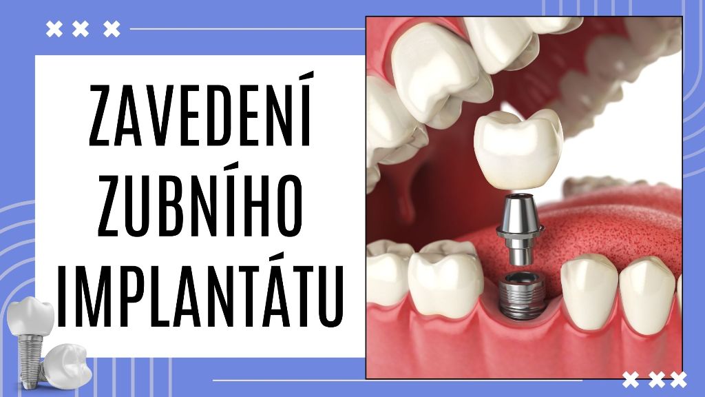 Zavedení zubního implantátu krok za krokem - Zavedení zubního implantátu