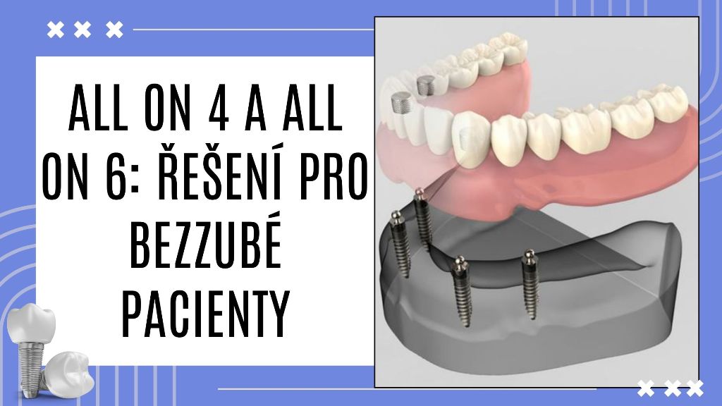 All on 4 a All on 6_ Řešení pro bezzubé pacienty