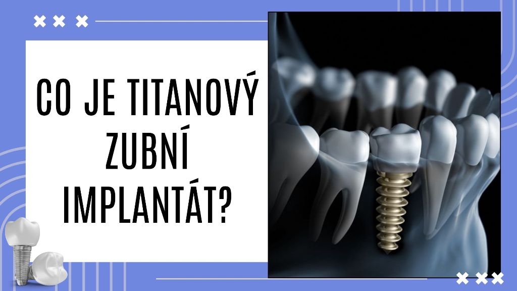 Co je titanový zubní implantát