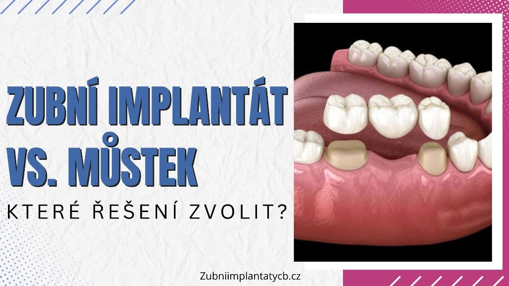 Zubní implantát vs. můstek_ Které řešení zvolit