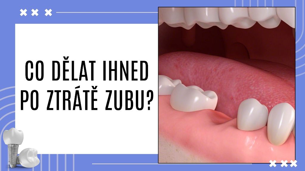 Co dělat ihned po ztrátě zubu?