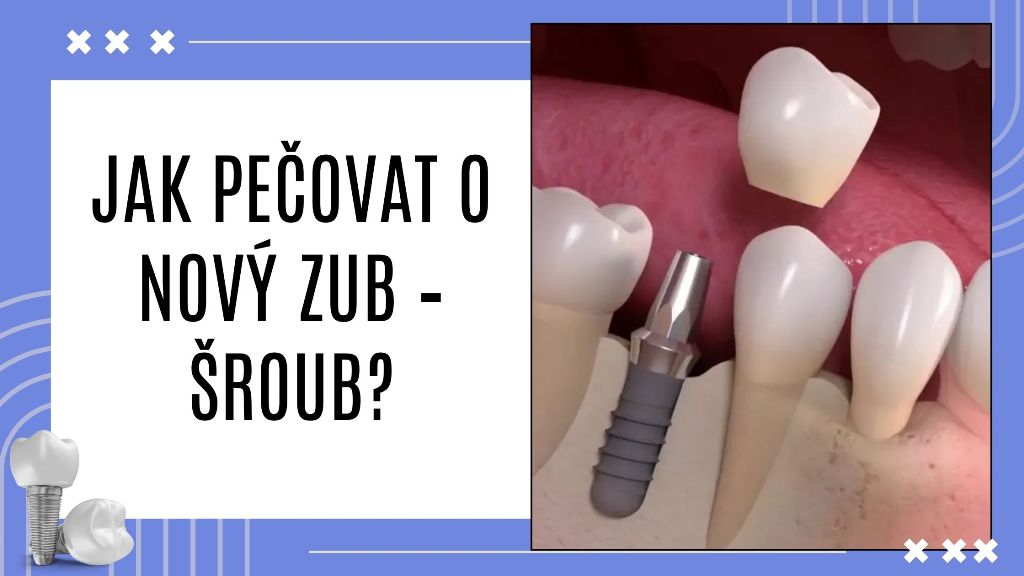 Jak pečovat o nový zub – šroub?