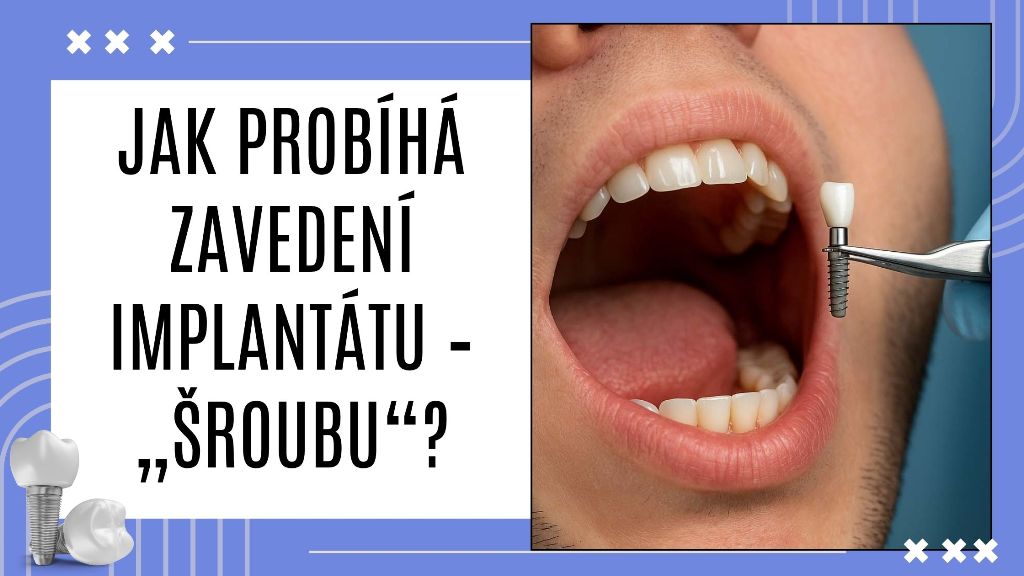 Jak probíhá zavedení implantátu – „šroubu“?