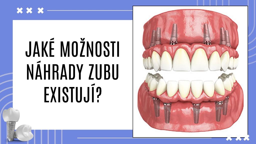 Jaké možnosti náhrady zubu existují?